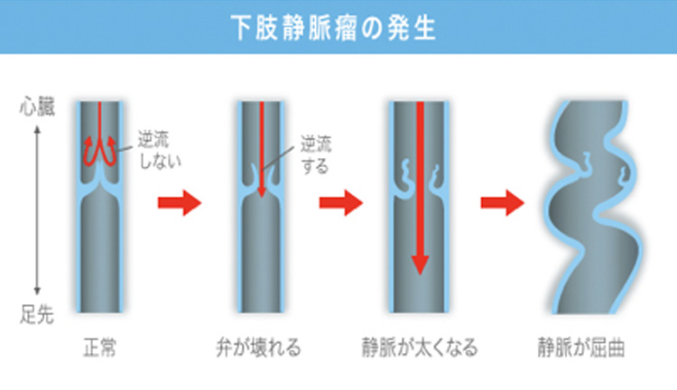 下肢静脈瘤のメカニズム