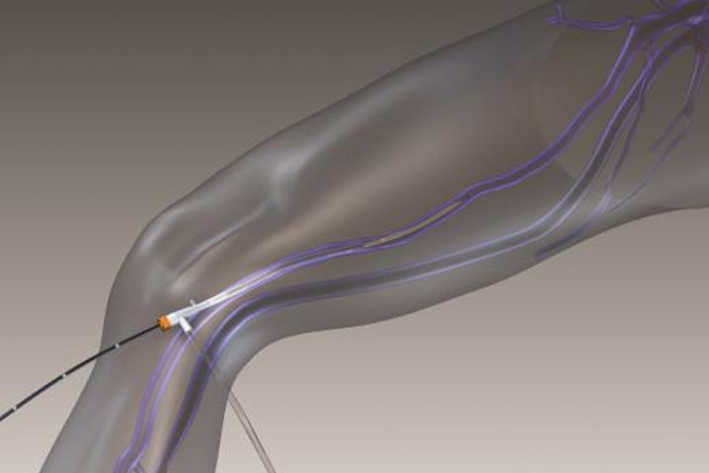 下肢静脈瘤用Closure_ClosureRFG%20Generatorの使用イメージ